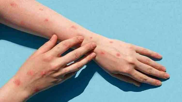 Pakistan confirms first monkeypox case of 2024 - Health